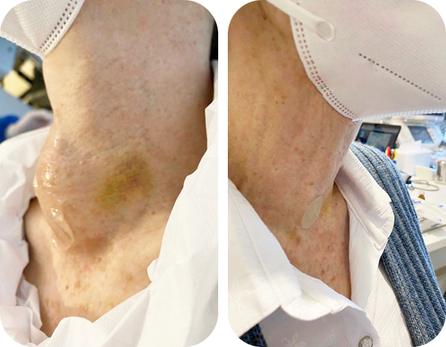 pulsão-de-nódulos-da-tireoide-15