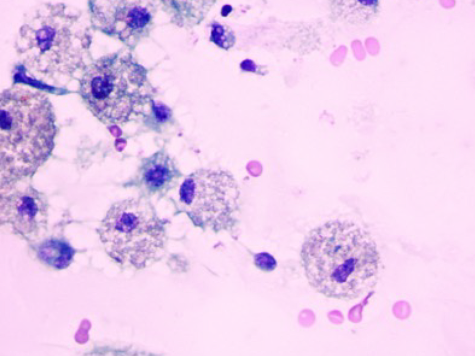 Classificação de Bethesda é uma escala de risco de malignidade dos nódulos de tireoide utilizada após a realização da PAAF. Dra Vanessa Cherniauskas