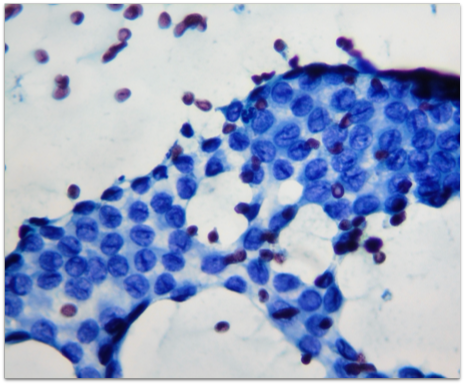 Citologia tireoide - Bethesda V