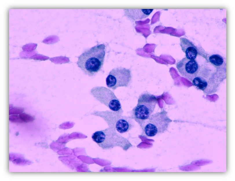 Carcinoma medular de tireoide
