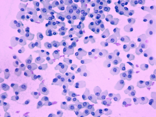 Células oncocíticas - Células de Hurthle